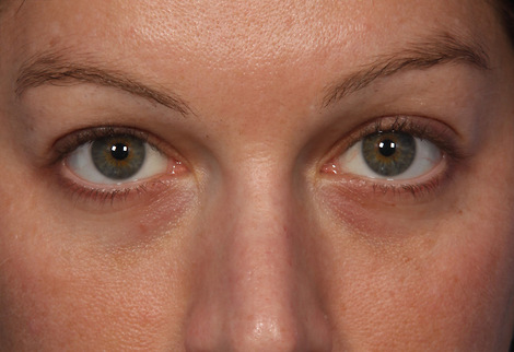 Injectable Fillers before and after photo