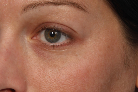 Injectable Fillers before and after photo