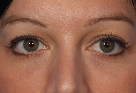 Injectable Fillers before and after photo