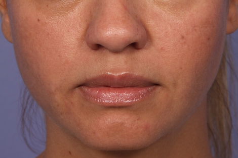 Injectable Fillers before and after photo