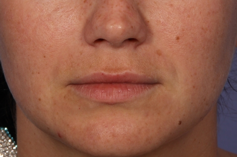 Injectable Fillers before and after photo