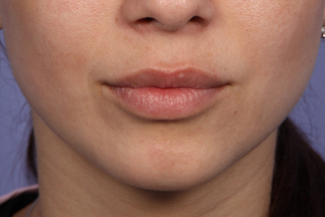 Injectable Fillers before and after photo