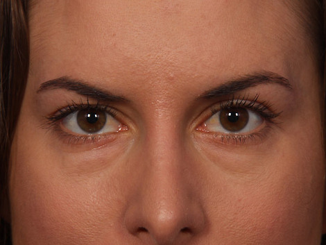 Injectable Fillers before and after photo