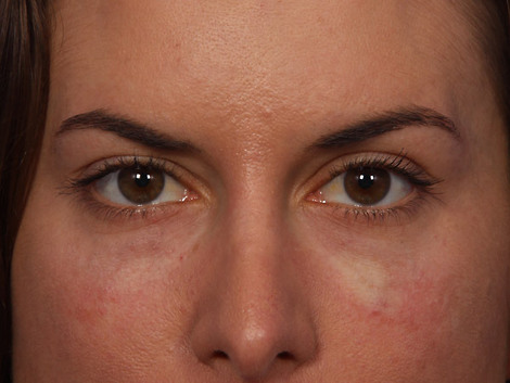 Injectable Fillers before and after photo