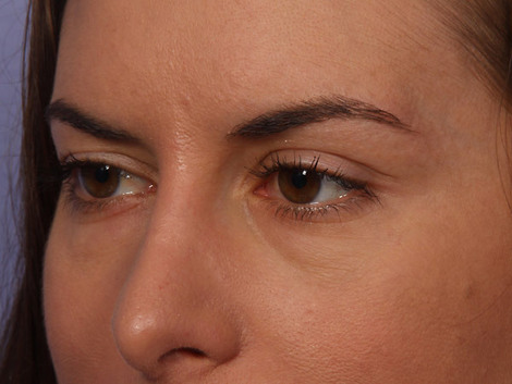 Injectable Fillers before and after photo