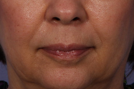 Injectable Fillers before and after photo