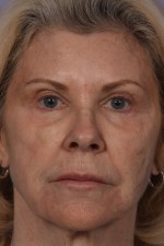 Injectable Fillers Before and after photo