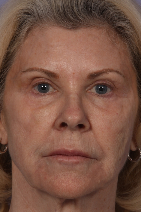 Injectable Fillers before and after photo