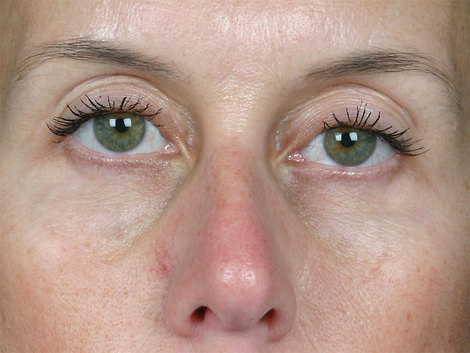 Injectable Fillers before and after photo