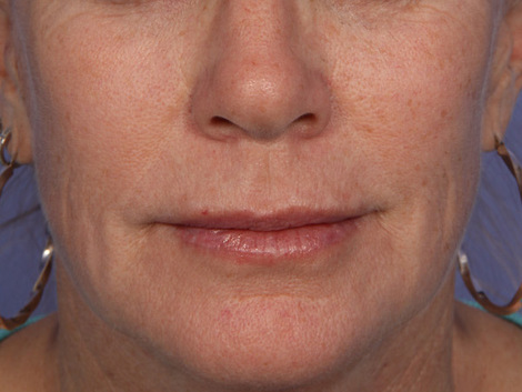 Injectable Fillers before and after photo