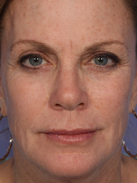 Injectable Fillers before and after photo