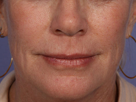 Injectable Fillers before and after photo