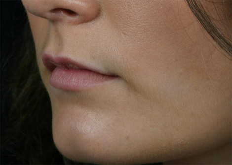 Injectable Fillers before and after photo