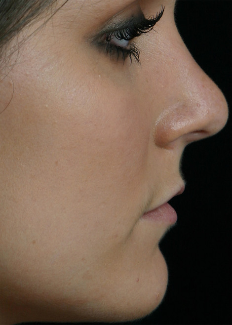 Injectable Fillers before and after photo