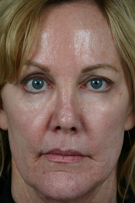 Injectable Fillers before and after photo