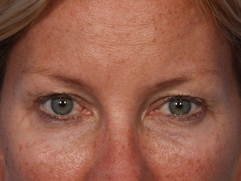 Injectable Fillers before and after photo