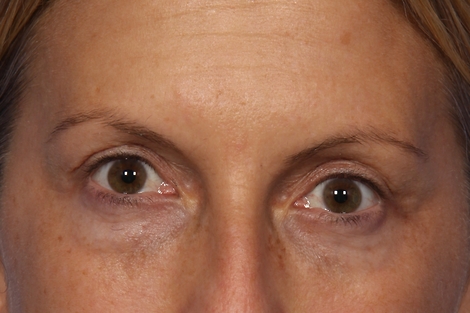 Injectable Fillers before and after photo