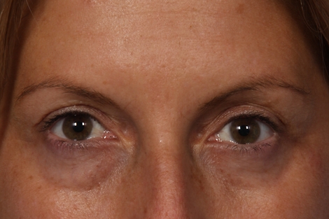 Injectable Fillers before and after photo