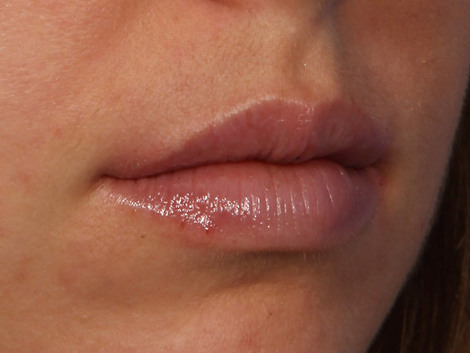 Injectable Fillers before and after photo