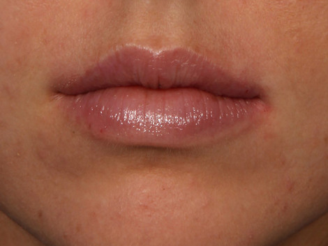 Injectable Fillers before and after photo