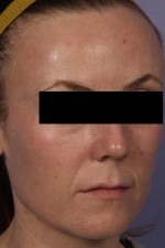 Laser Skin Resurfacing Before and after photo