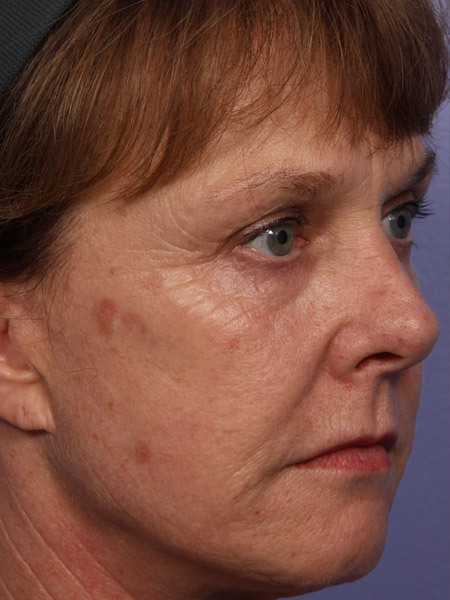 Laser Skin Resurfacing before and after photo