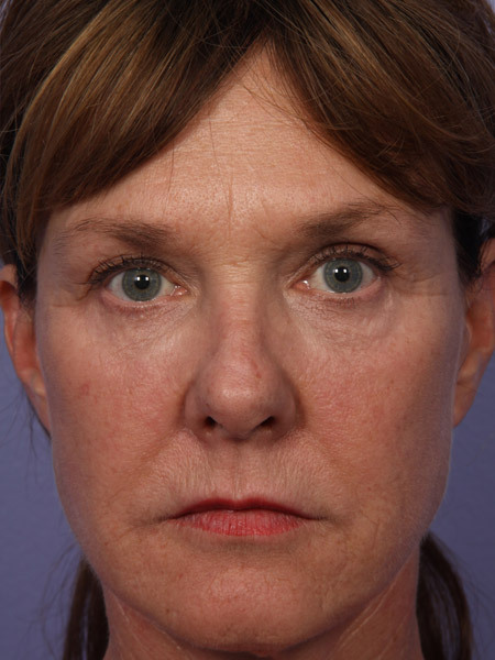 Laser Skin Resurfacing before and after photo