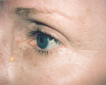 Laser Skin Resurfacing before and after photo