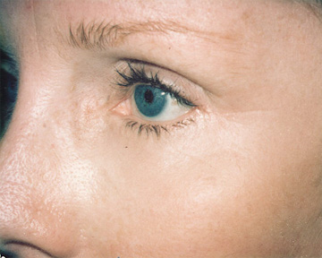 Laser Skin Resurfacing before and after photo