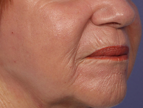 Laser Skin Resurfacing before and after photo