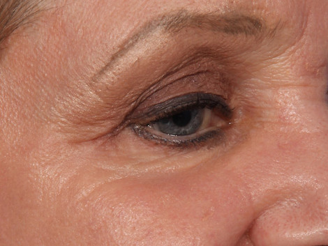 Laser Skin Resurfacing before and after photo