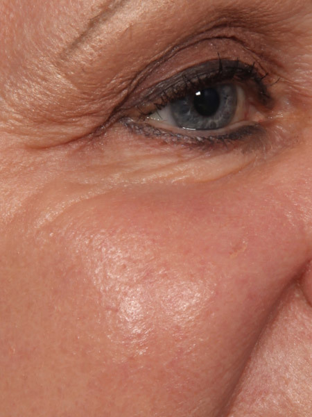 Laser Skin Resurfacing before and after photo