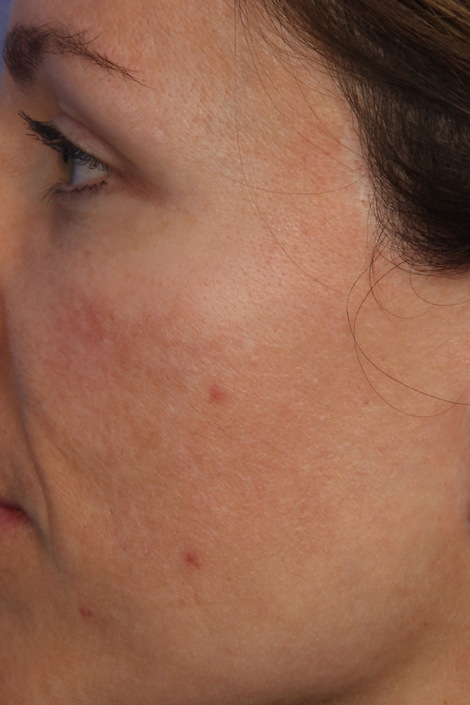 Laser Skin Resurfacing before and after photo