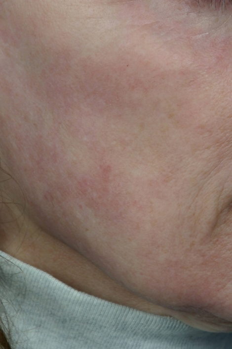 Laser Skin Resurfacing before and after photo