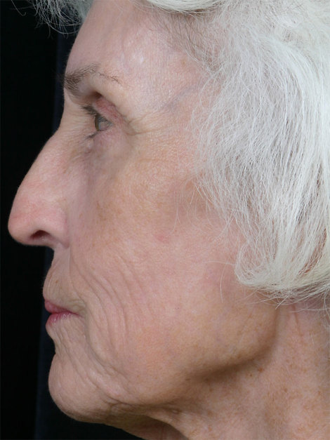 Laser Skin Resurfacing before and after photo