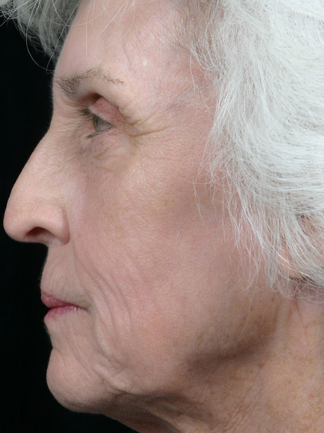 Laser Skin Resurfacing before and after photo