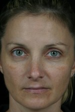 Laser Skin Resurfacing