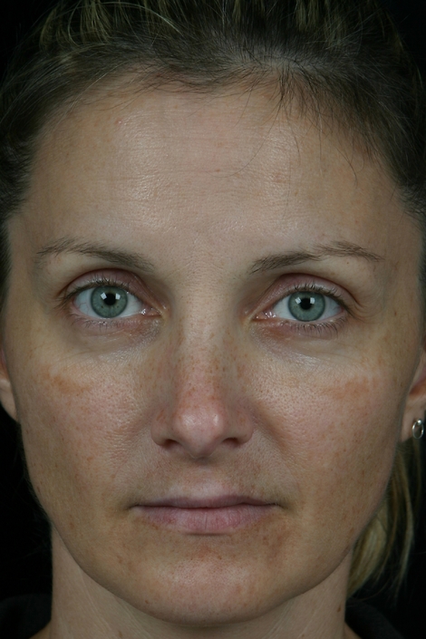 Laser Skin Resurfacing before and after photo