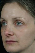 Laser Skin Resurfacing Before and after photo