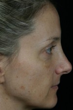 Laser Skin Resurfacing Before and after photo