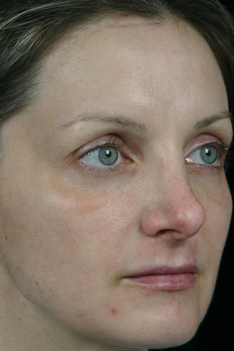 Laser Skin Resurfacing before and after photo