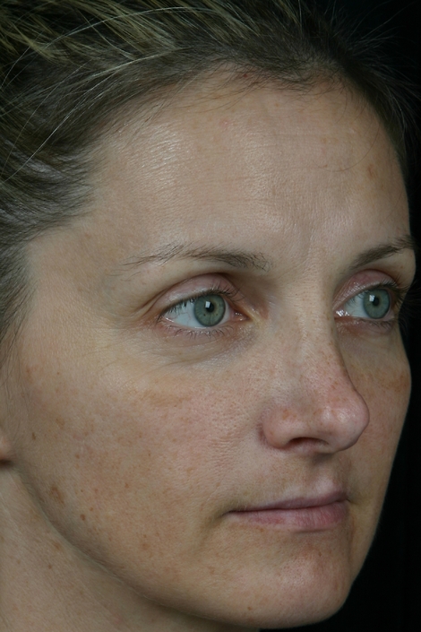 Laser Skin Resurfacing before and after photo