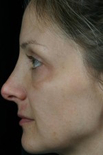 Laser Skin Resurfacing Before and after photo