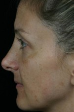 Laser Skin Resurfacing Before and after photo