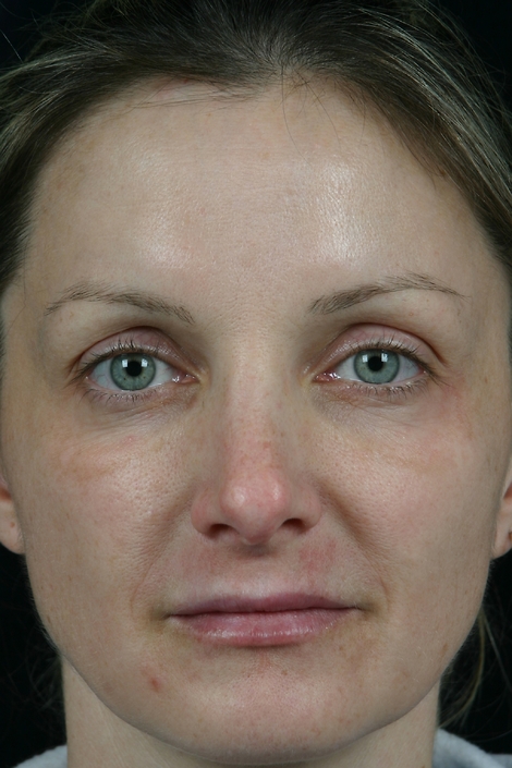 Laser Skin Resurfacing before and after photo