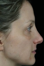 Laser Skin Resurfacing Before and after photo