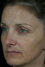 Laser Skin Resurfacing Before and after photo