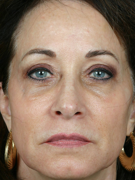 Laser Skin Resurfacing before and after photo