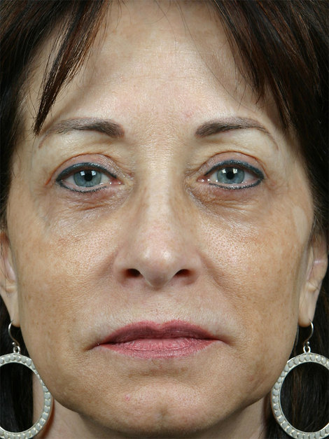 Laser Skin Resurfacing before and after photo