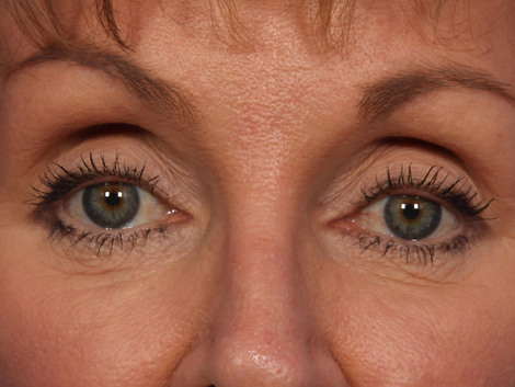 Laser Skin Resurfacing before and after photo